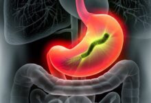 Photo of Симптомы гастрита и его лечение