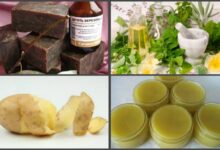 Photo of Лечение псориаза народными методами