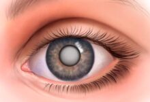 Photo of Симптомы и лечение катаракты