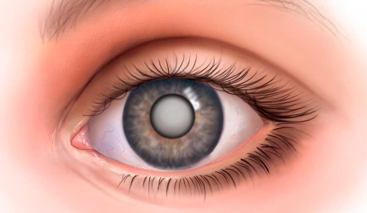 Фото 26 — Симптомы и лечение катаракты