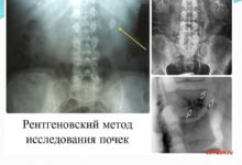 Photo of Гломерулонефрит: противовоспалительные препараты и анализы