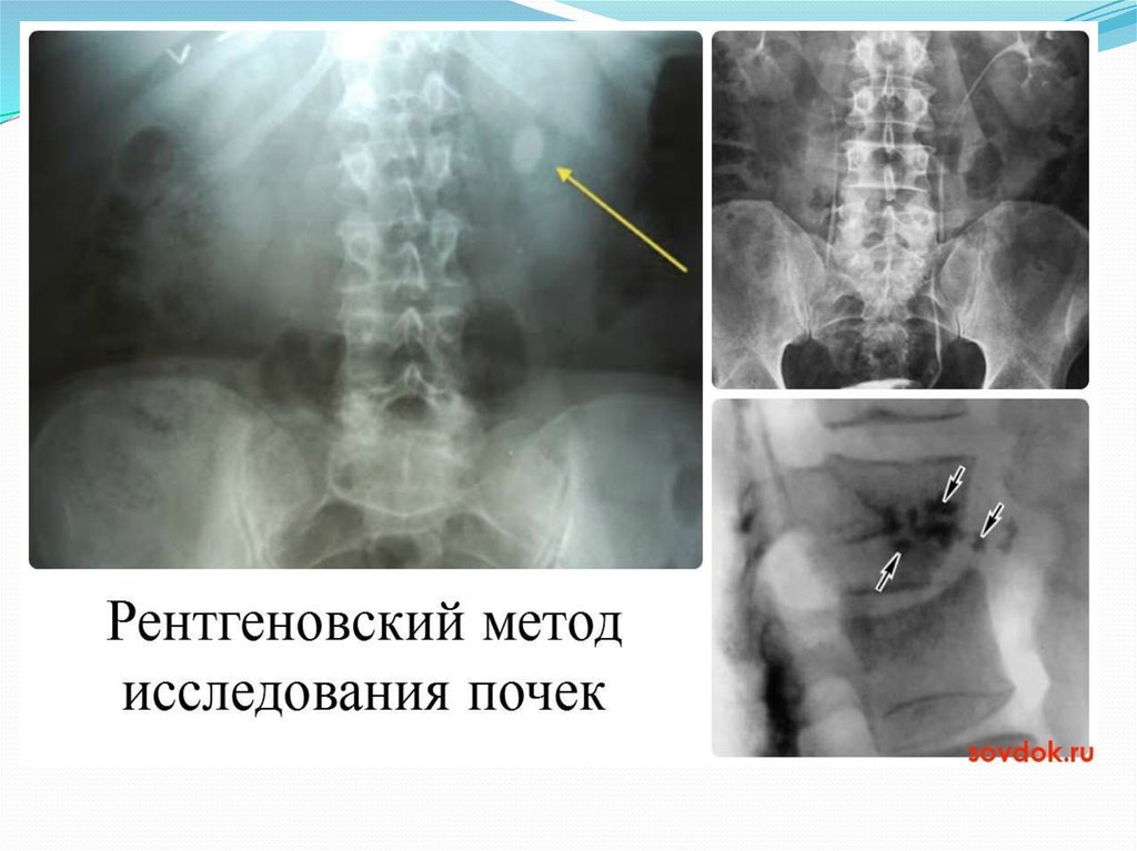 Фото 33 — Гломерулонефрит: противовоспалительные препараты и анализы